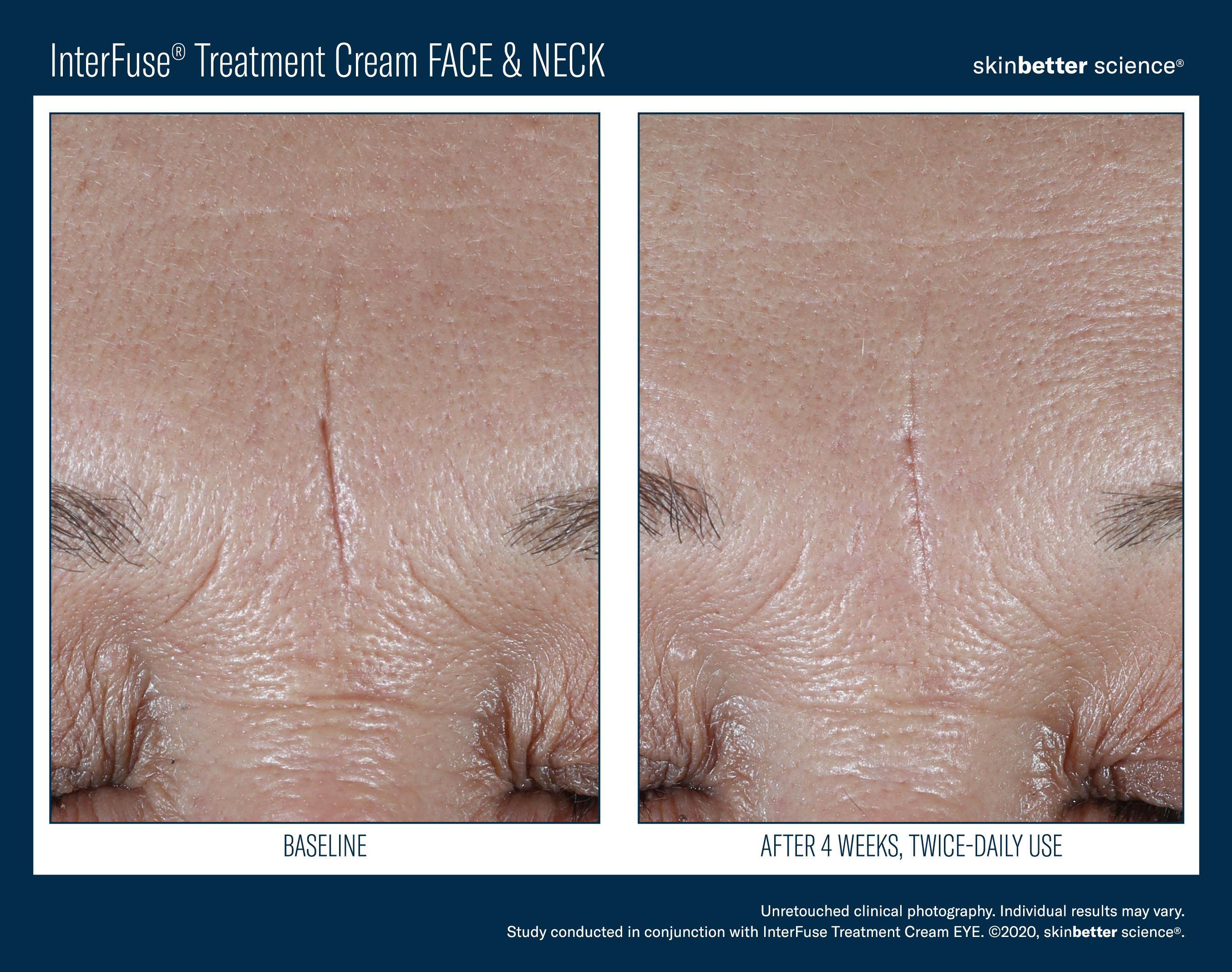 InterFuse Treatment Cream