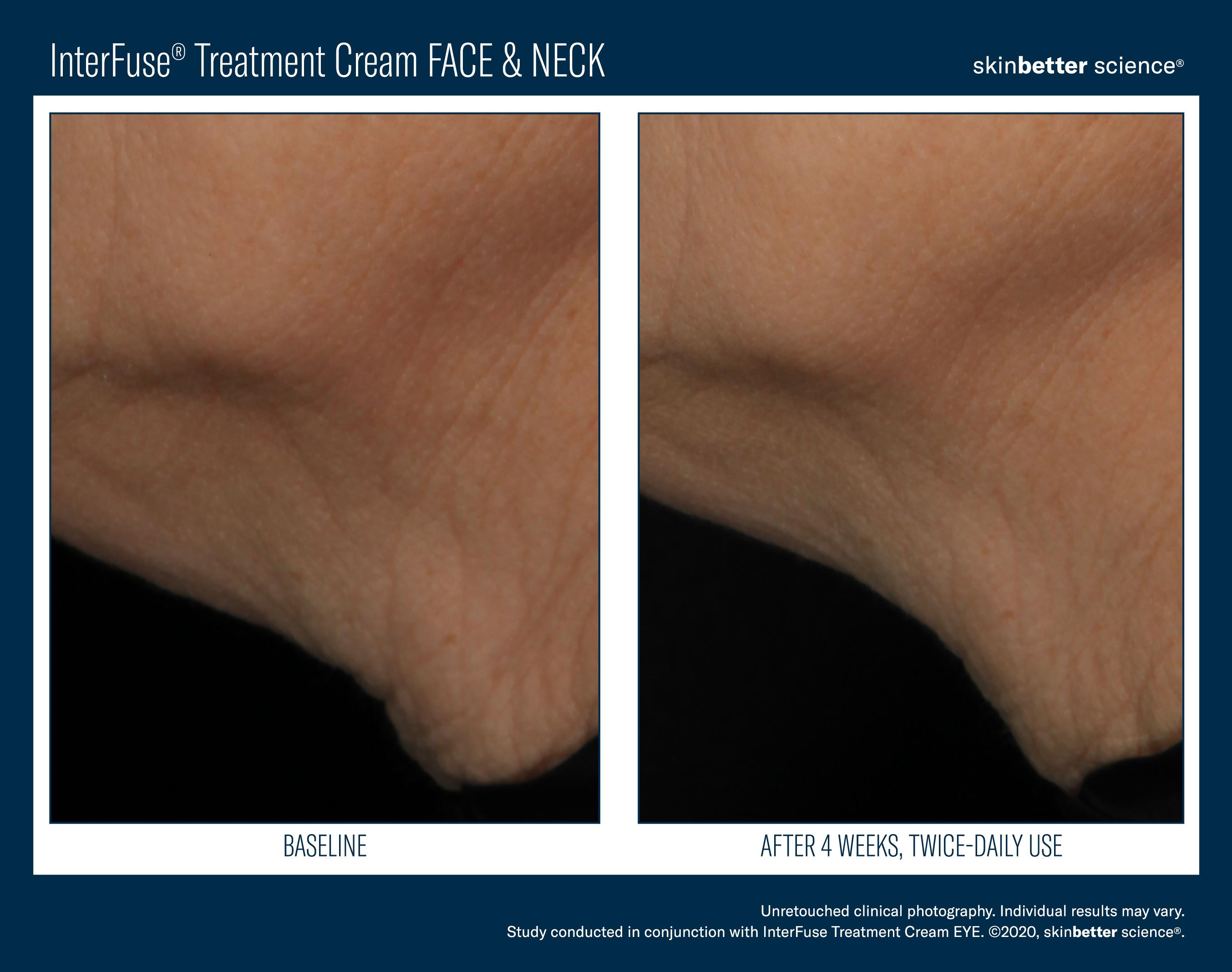 InterFuse Treatment Cream