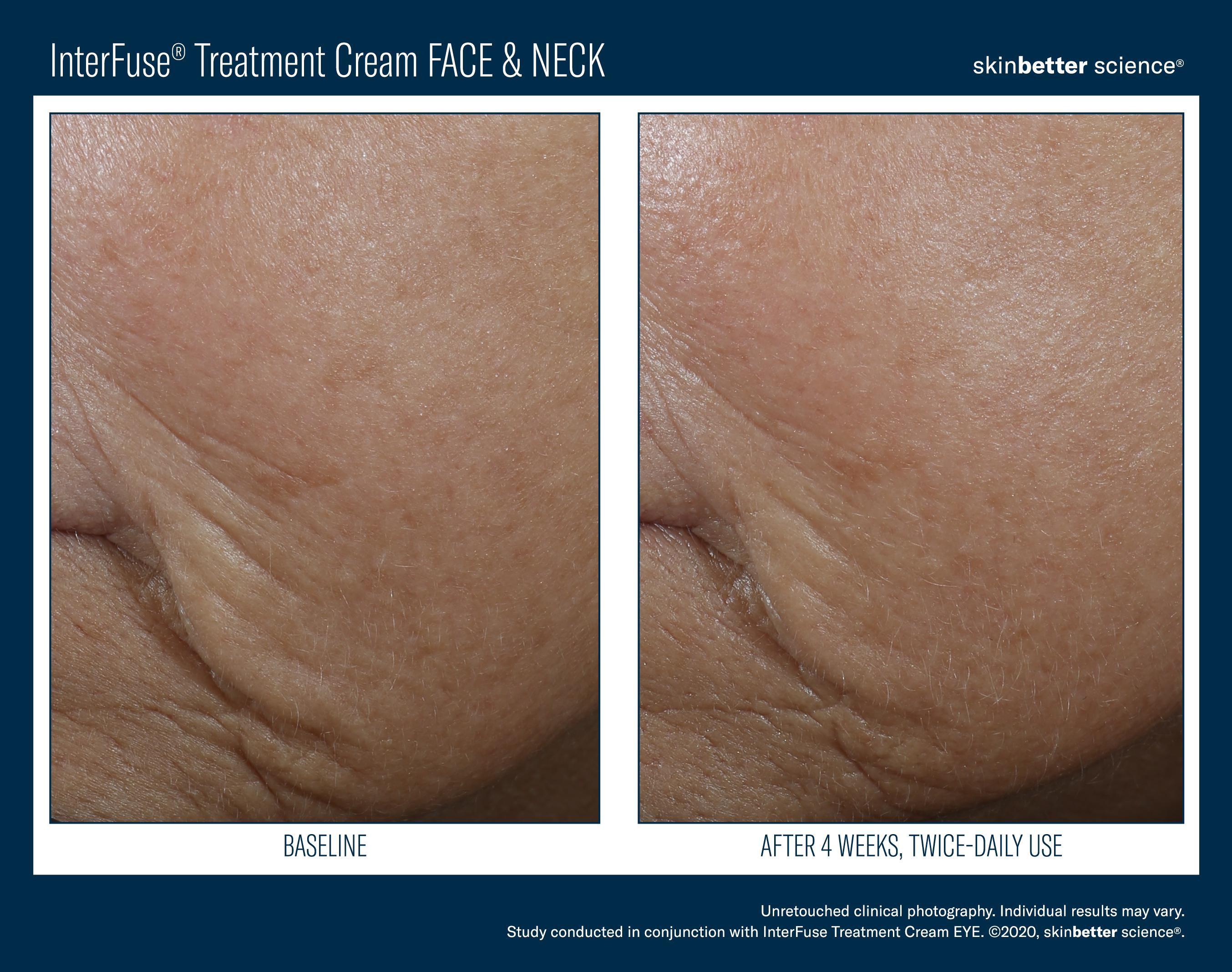 InterFuse Treatment Cream