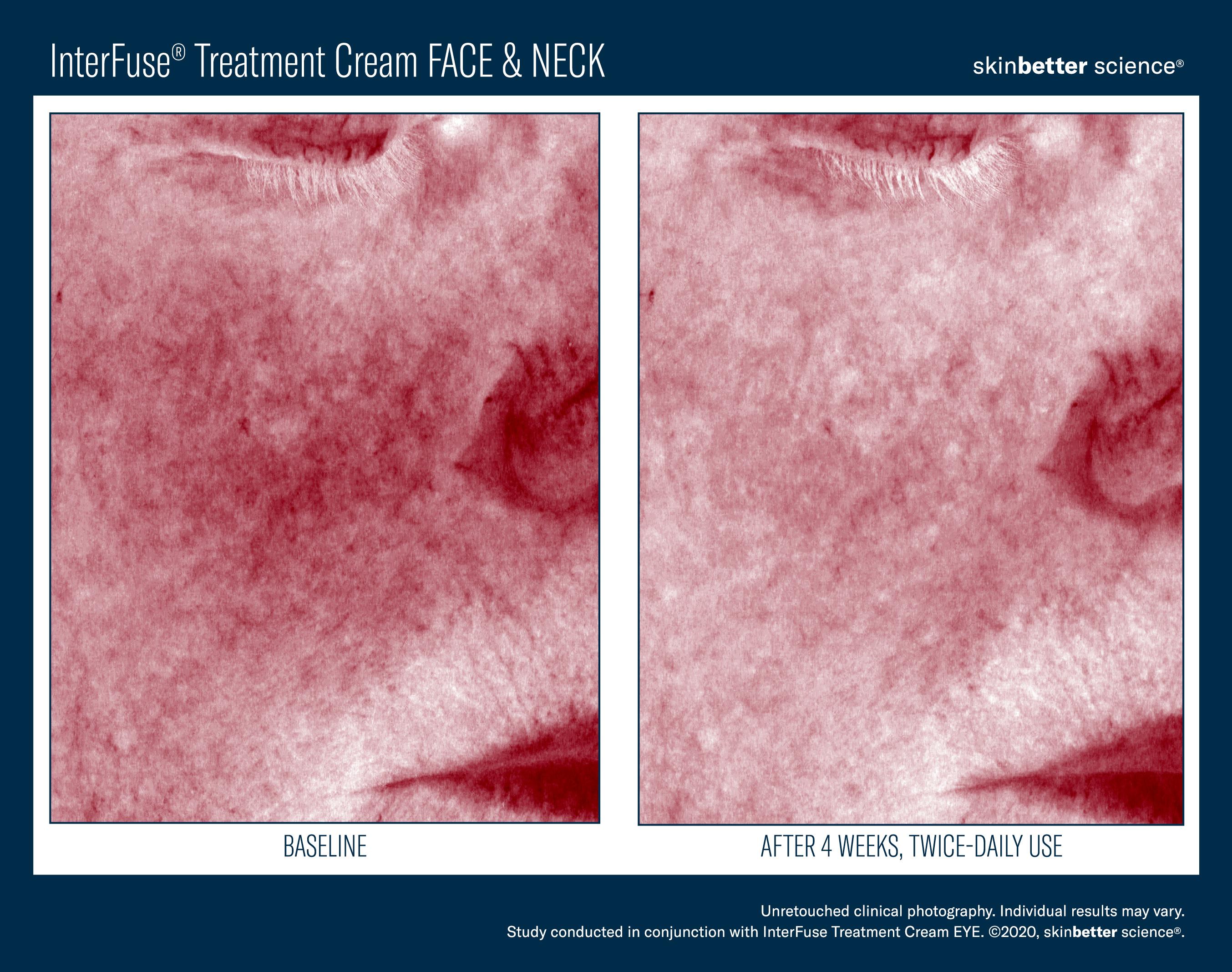 InterFuse Treatment Cream