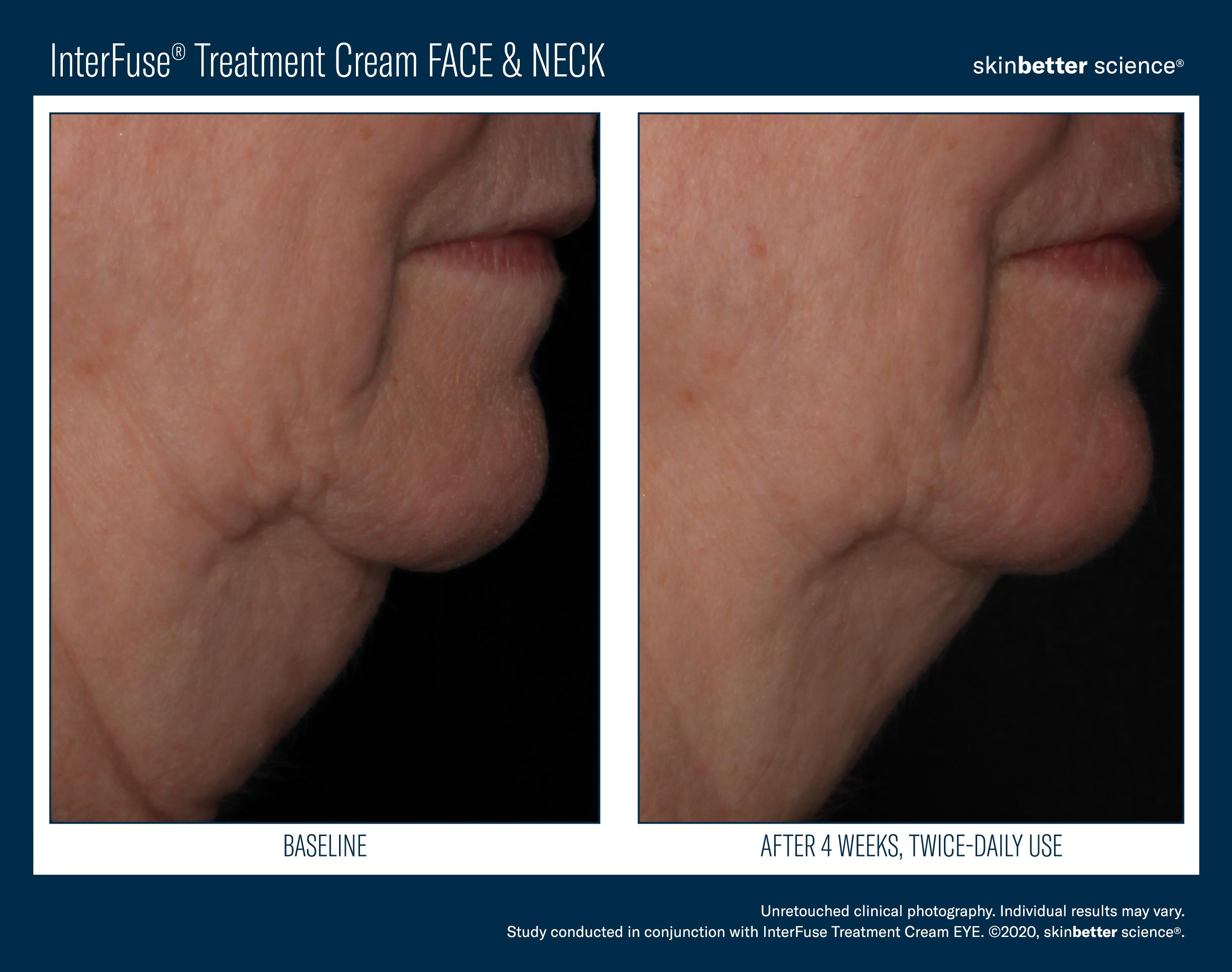 InterFuse Treatment Cream