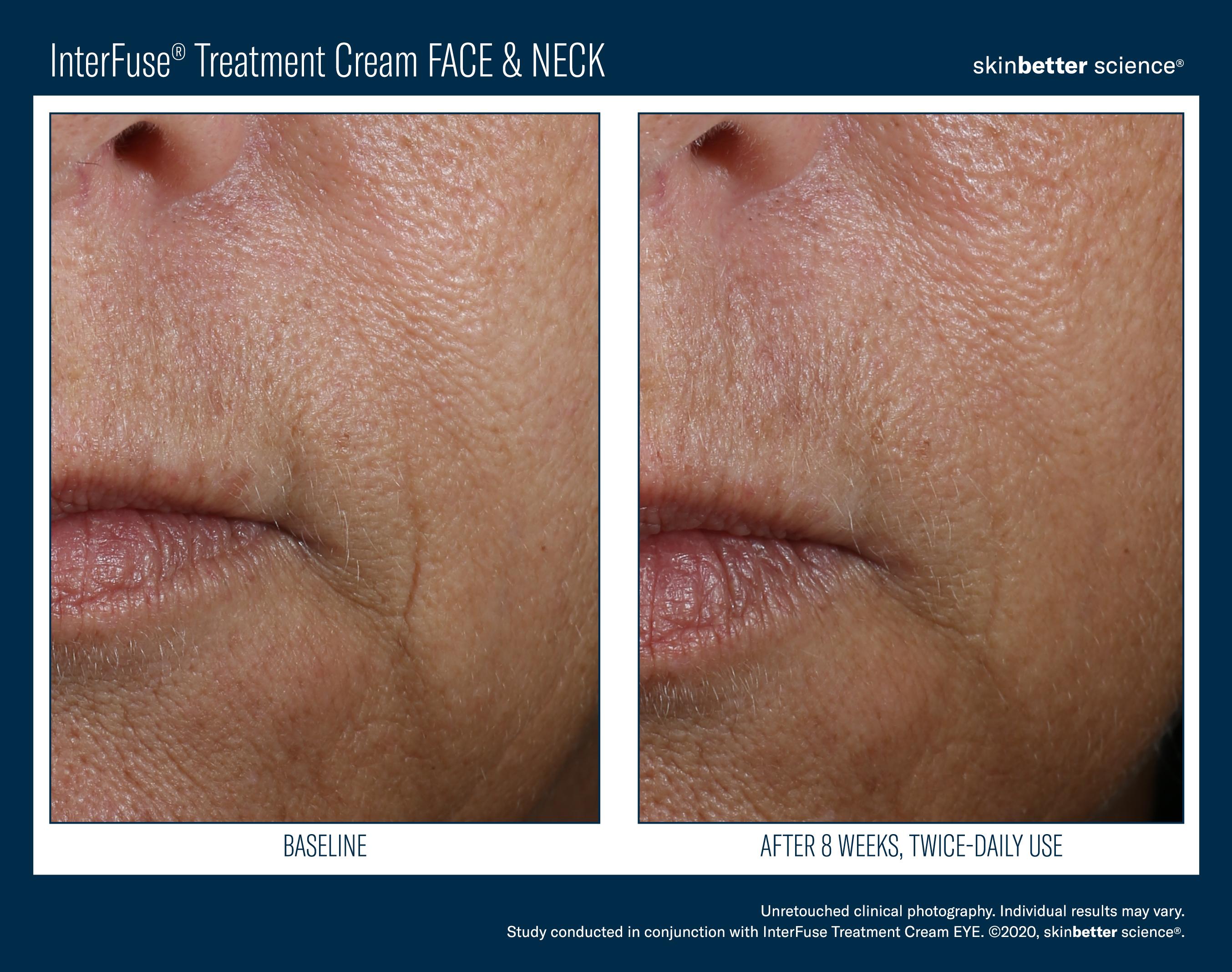 InterFuse Treatment Cream