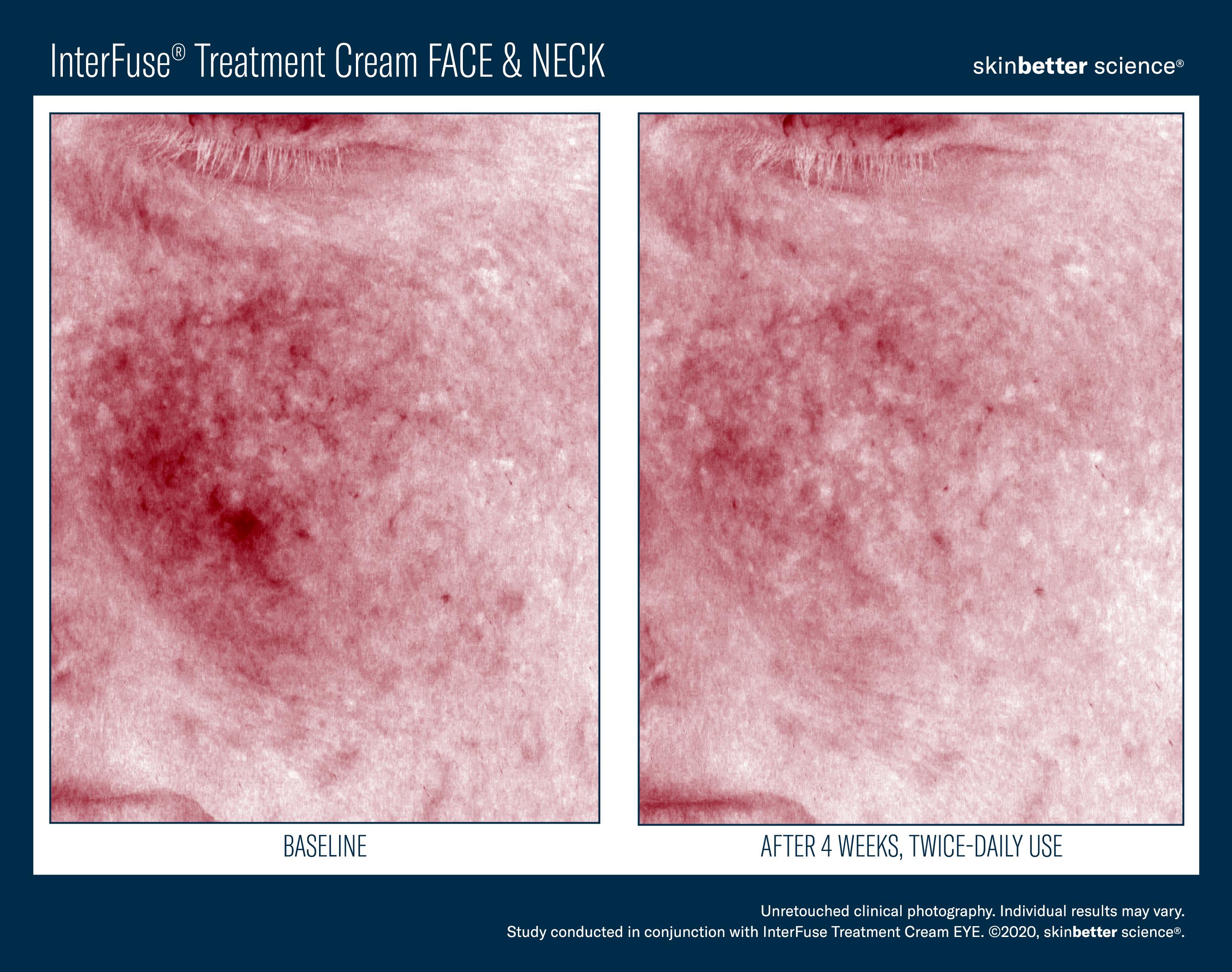 InterFuse Treatment Cream