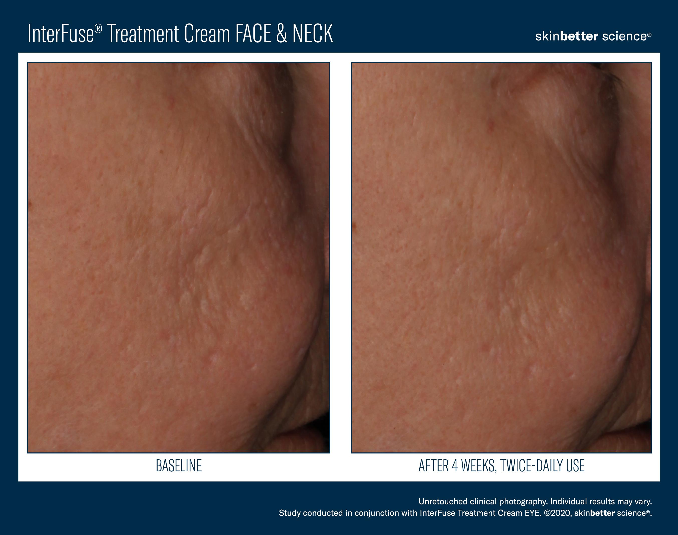 InterFuse Treatment Cream