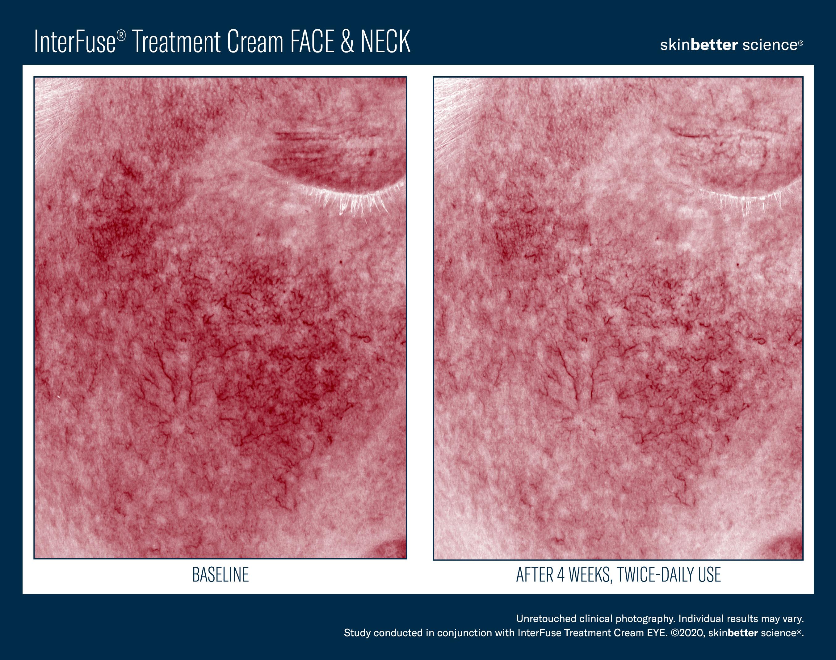 InterFuse Treatment Cream