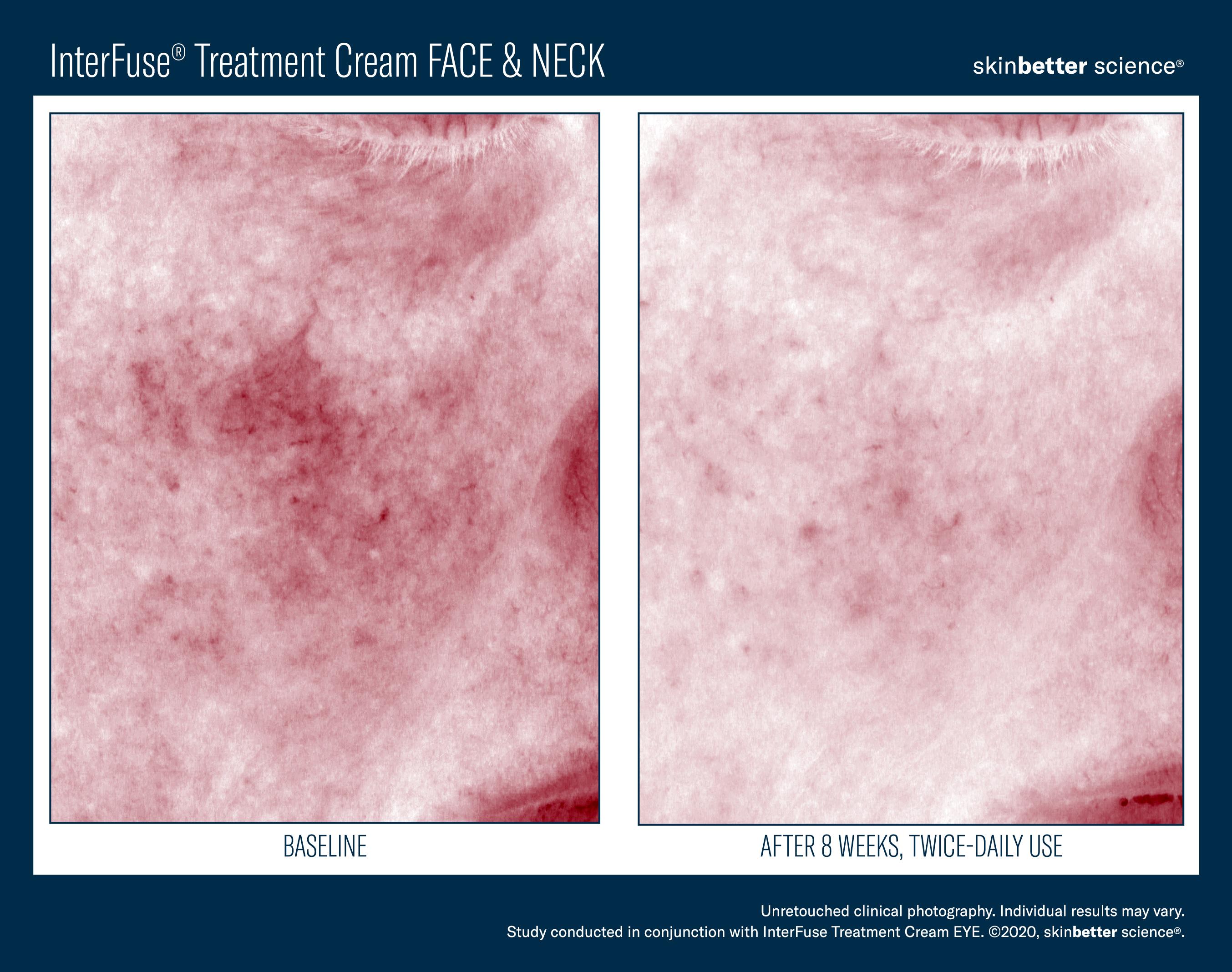 InterFuse Treatment Cream