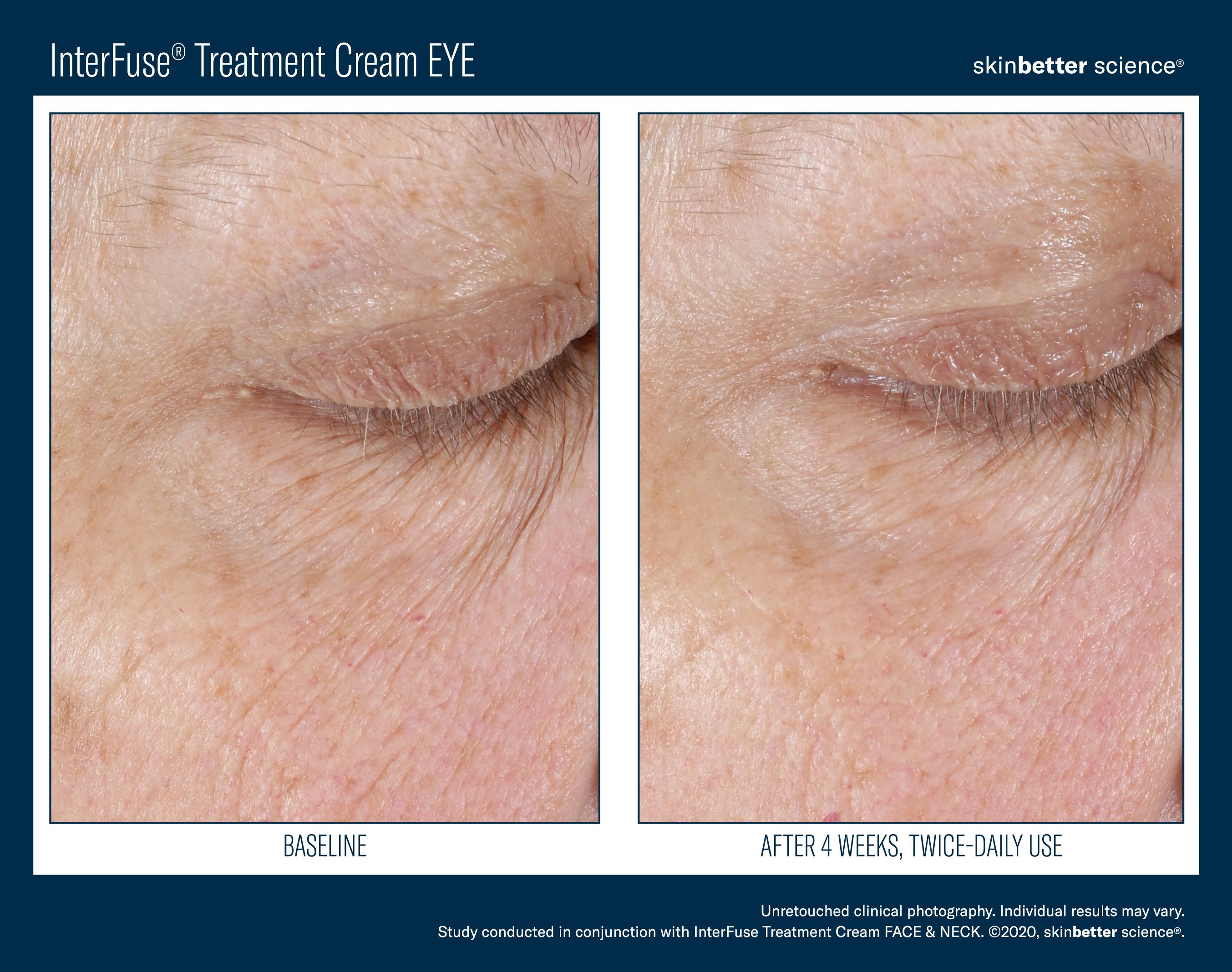 InterFuse Treatment Cream EYE