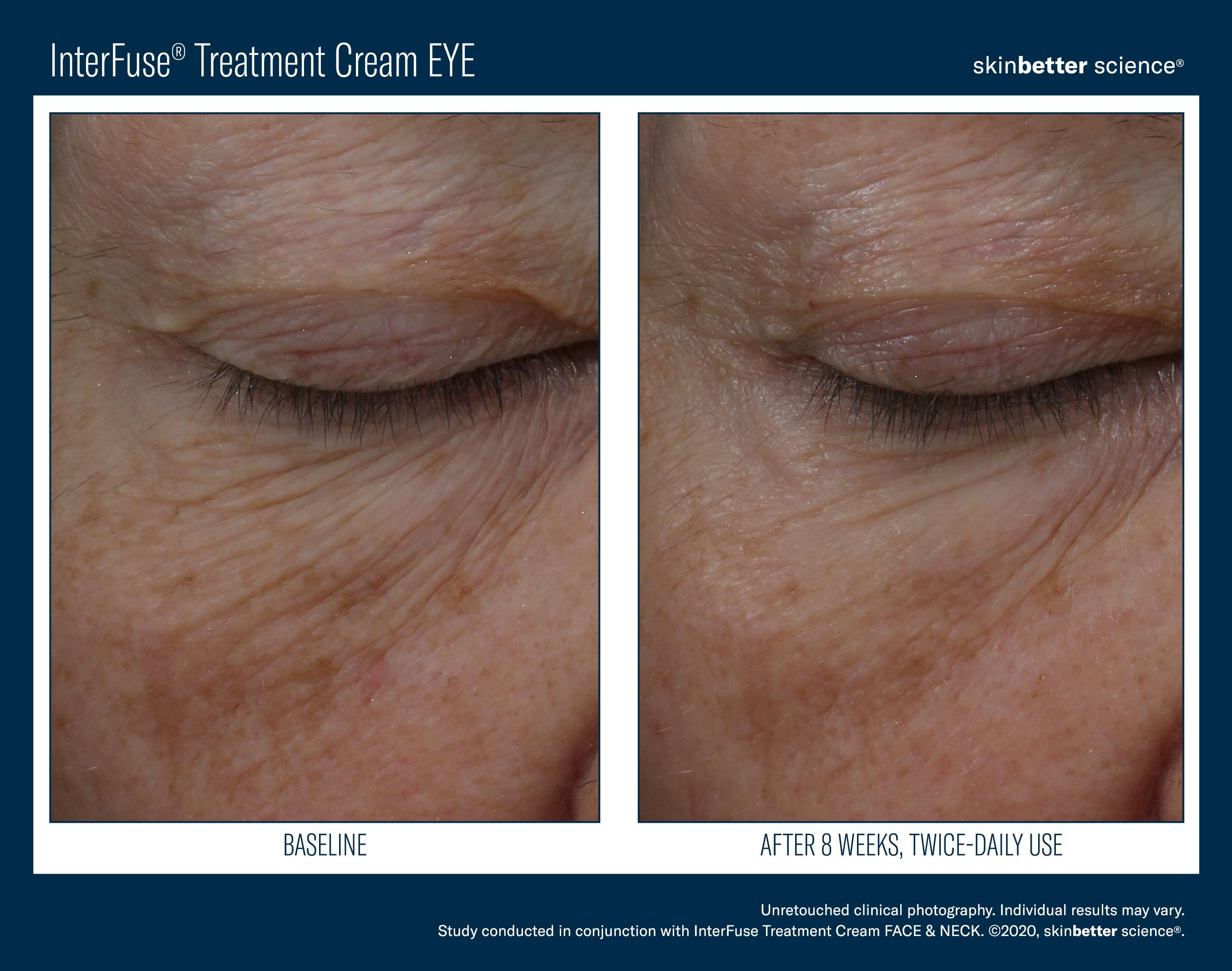 InterFuse Treatment Cream EYE