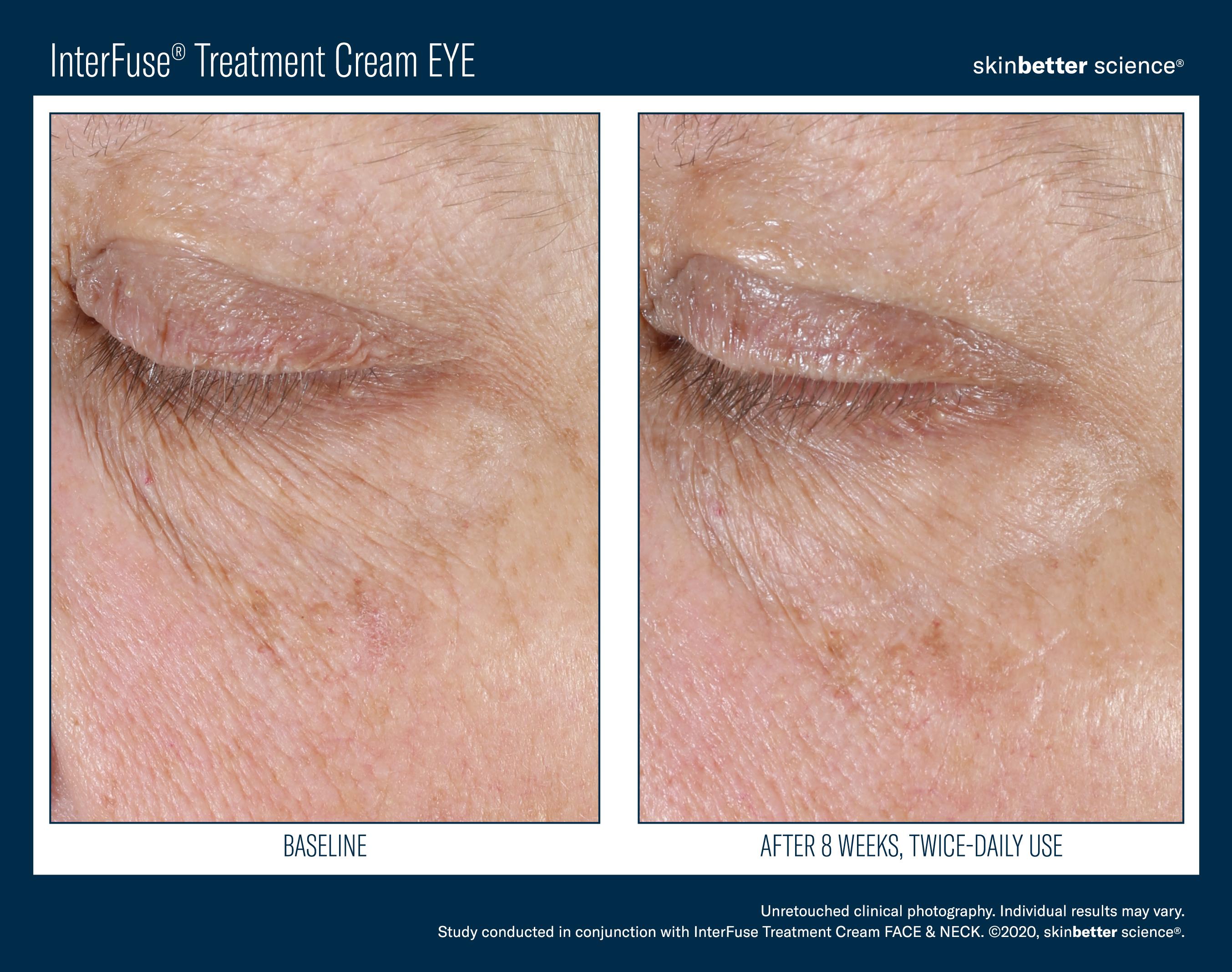 InterFuse Treatment Cream EYE