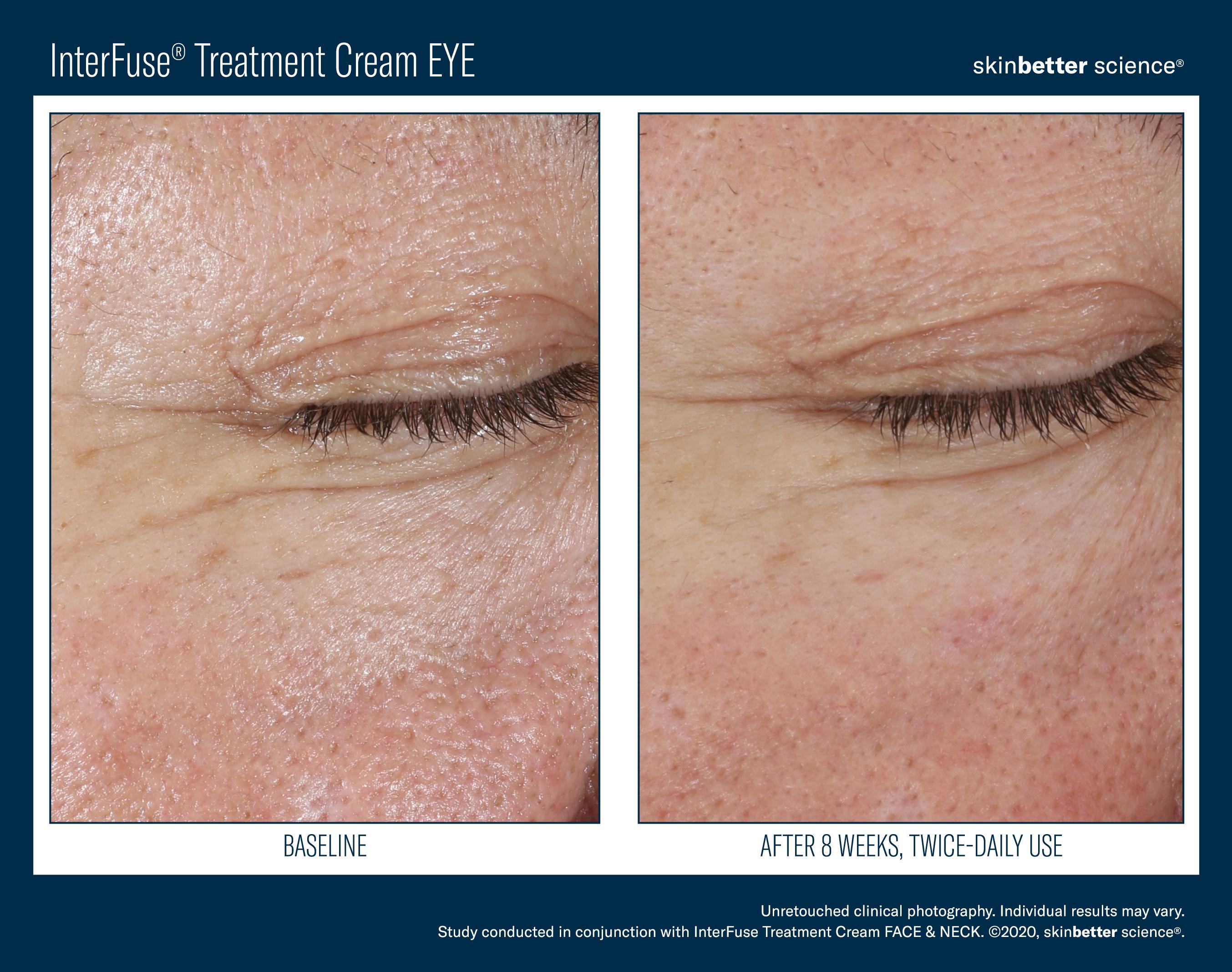 InterFuse Treatment Cream EYE