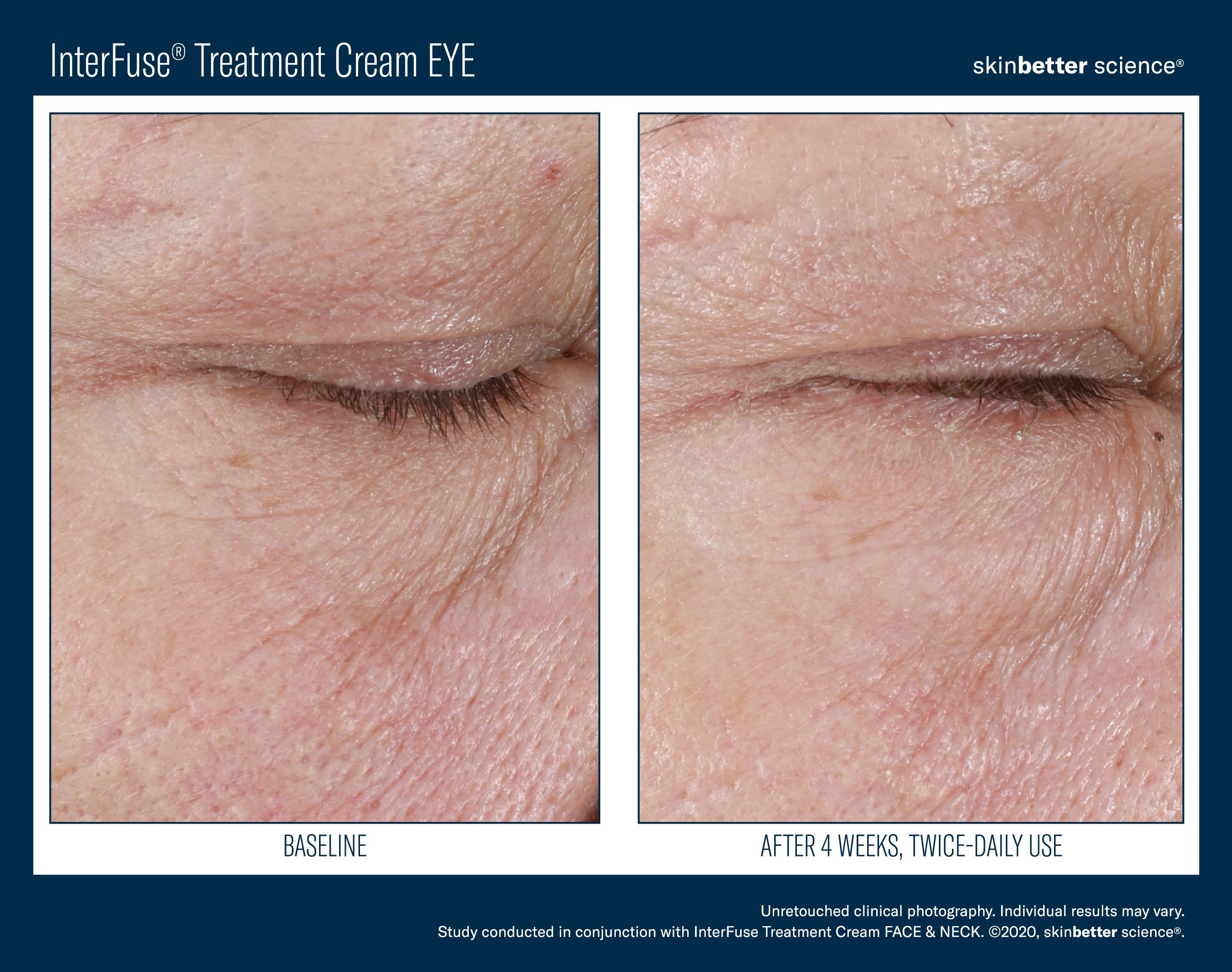 InterFuse Treatment Cream EYE